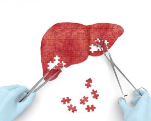 Key steps liver transplant